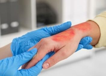 Situations Where Burn Injuries Lead to Legal Action